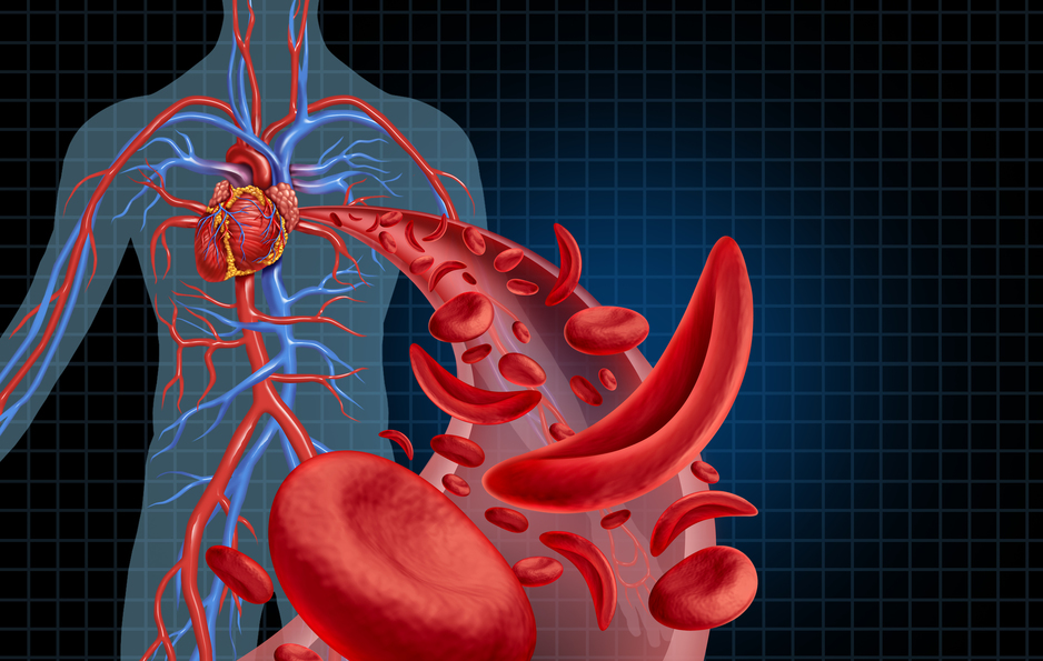 Sickle cell cardiovascular heart blood circulation and anemia as a disease with normal and abnormal hemoglobin in a human artery anatomy as a medical illustration concept with 3D illustration elements.