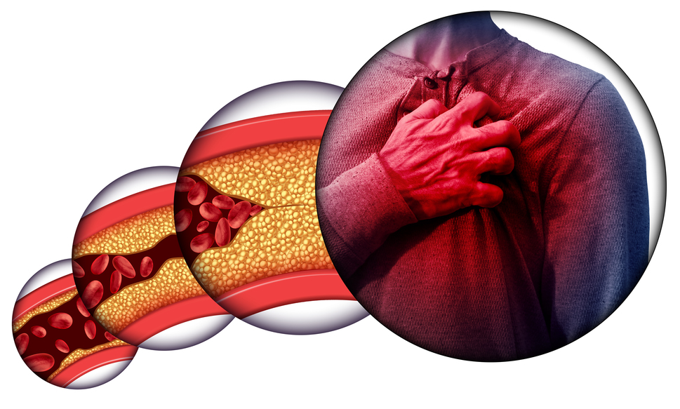 Human heart disease and chest pain from clogged arteries and artery damaged with cholesterol resulting in a cardiac arrest with 3D illustration elements.